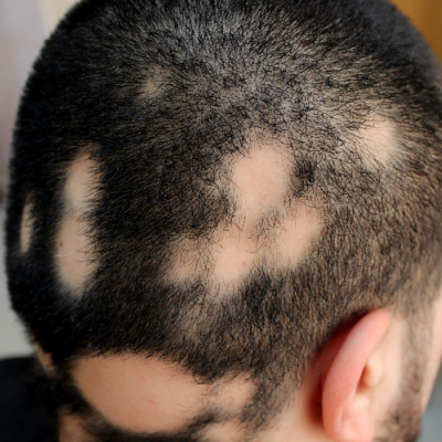  Alopecia Areata