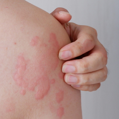 Clinical Studies for Psoriasis